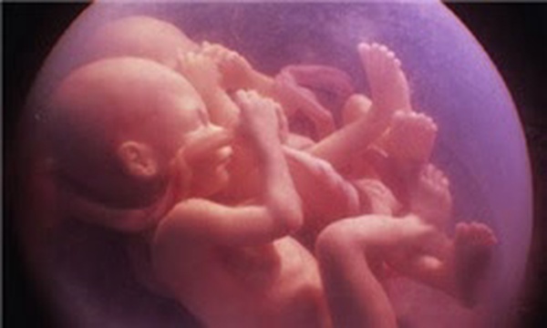 جنین چندقلو