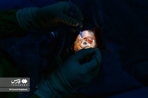  عمل جراحی رایگان چشم در بیمارستان علوی تبریز