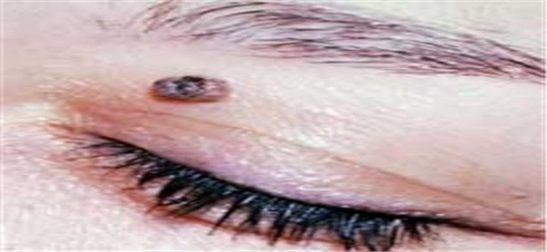 خال صورت